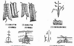 八字缝合法步骤