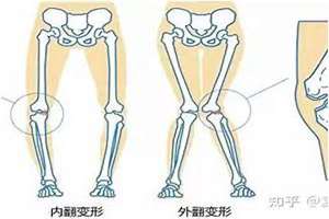 内八字的危害和治疗(内八字的危害)