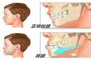 对刃齿怎么矫正(对刃齿面相)