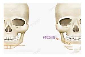 下颌骨较大面相怎么看(下颌骨较大面相)