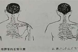 肩胛骨向前弯面相分析(肩胛骨向前弯面相)