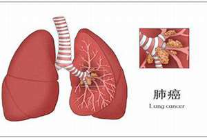 肺癌八字实例(肺癌八字)